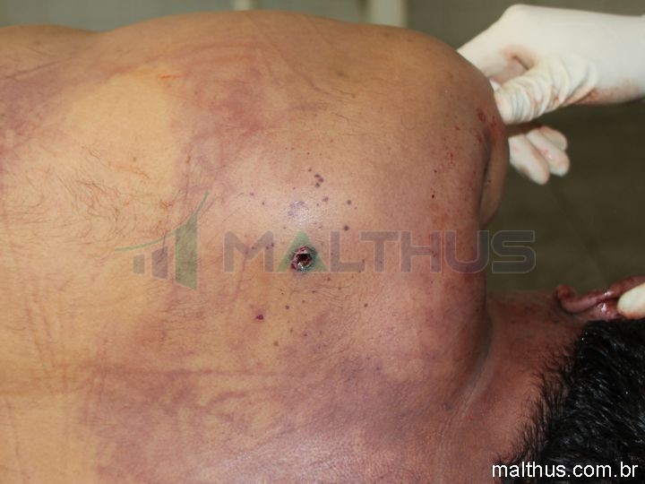Entrada de projetil de arma de fogo no dorso, com tatuagem, portanto, a curta distância. - Clique aqui para visualizar o Conjunto Caso PAF 10